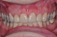 Cosmetic-Crowns-after