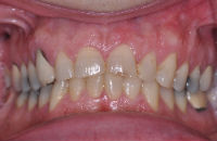 Cosmetic-Crowns-before