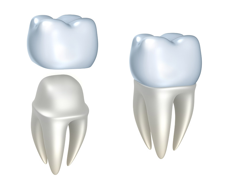 Dental-Crowns-and-Bridges-in-Kennewick-WA