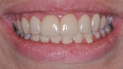 Veneers-after