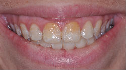 Veneers-before