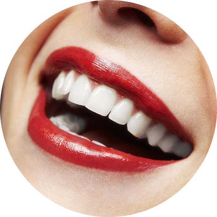 Veneers-in-Kennewick-WA