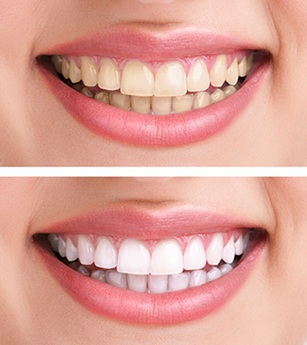 teeth-whitening-service-kennewick-wa