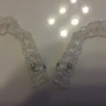 what-is-invisalign