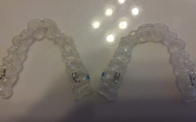 what-is-invisalign